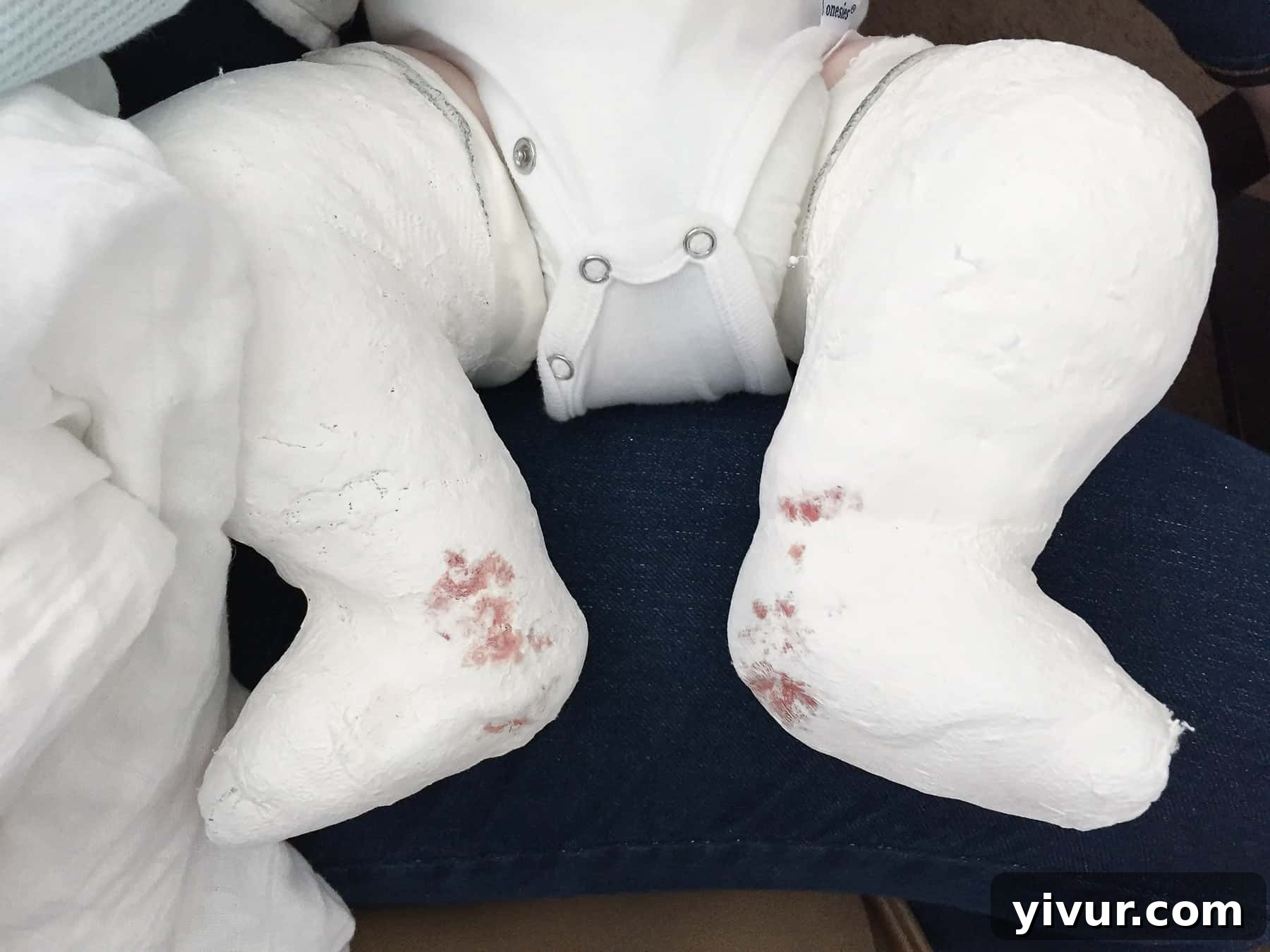 4 Yaşındaki Evladım Neden Alçıda ve Tekerlekli Sandalyede 12 Josh's casts after his second surgery, showing signs of blood, which is a normal part of the recovery process. He wore these casts for an extended period, followed by additional casting.