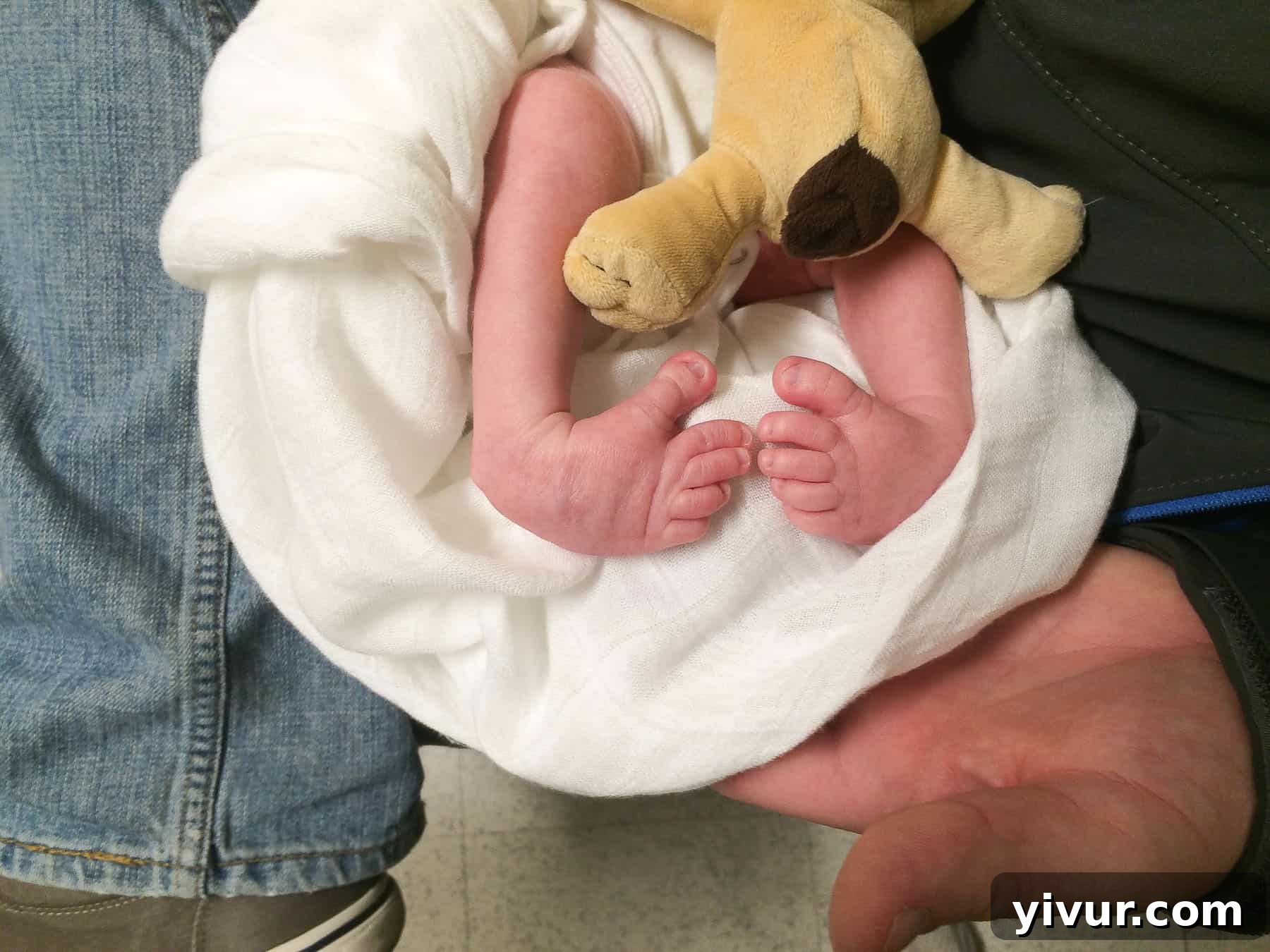 4 Yaşındaki Evladım Neden Alçıda ve Tekerlekli Sandalyede 3 Josh's clubfeet before correction, showing the inward rotation and lack of a 90-degree bend. This photo was taken right before his first set of casts, highlighting the severity of the congenital talipes equinovarus.