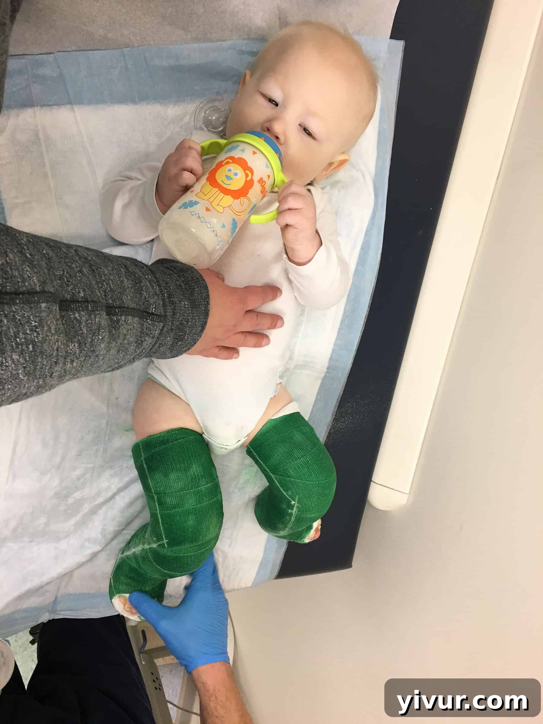 4 Yaşındaki Evladım Neden Alçıda ve Tekerlekli Sandalyede 21 Josh getting his casts removed, a challenging but necessary step in his clubfoot treatment. His parents used singing and milk to distract him from the noise of the saw.