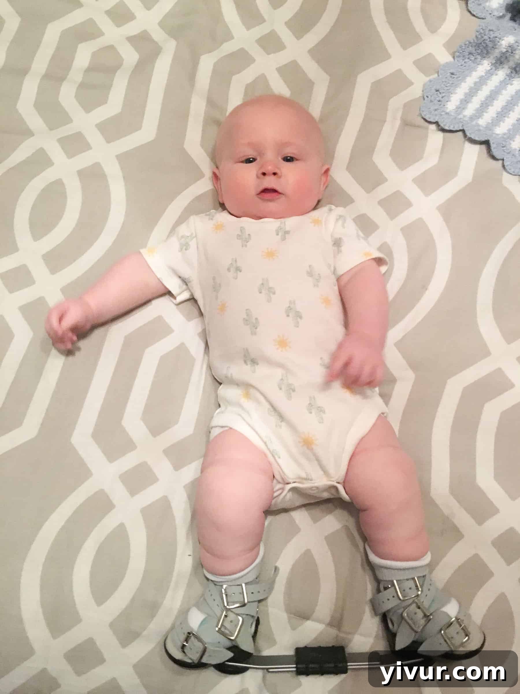 4 Yaşındaki Evladım Neden Alçıda ve Tekerlekli Sandalyede 8 Josh wearing his boots and bar brace after the first round of clubfoot correction, at approximately three months old. This brace was vital for preventing relapse and maintaining the corrected foot position.