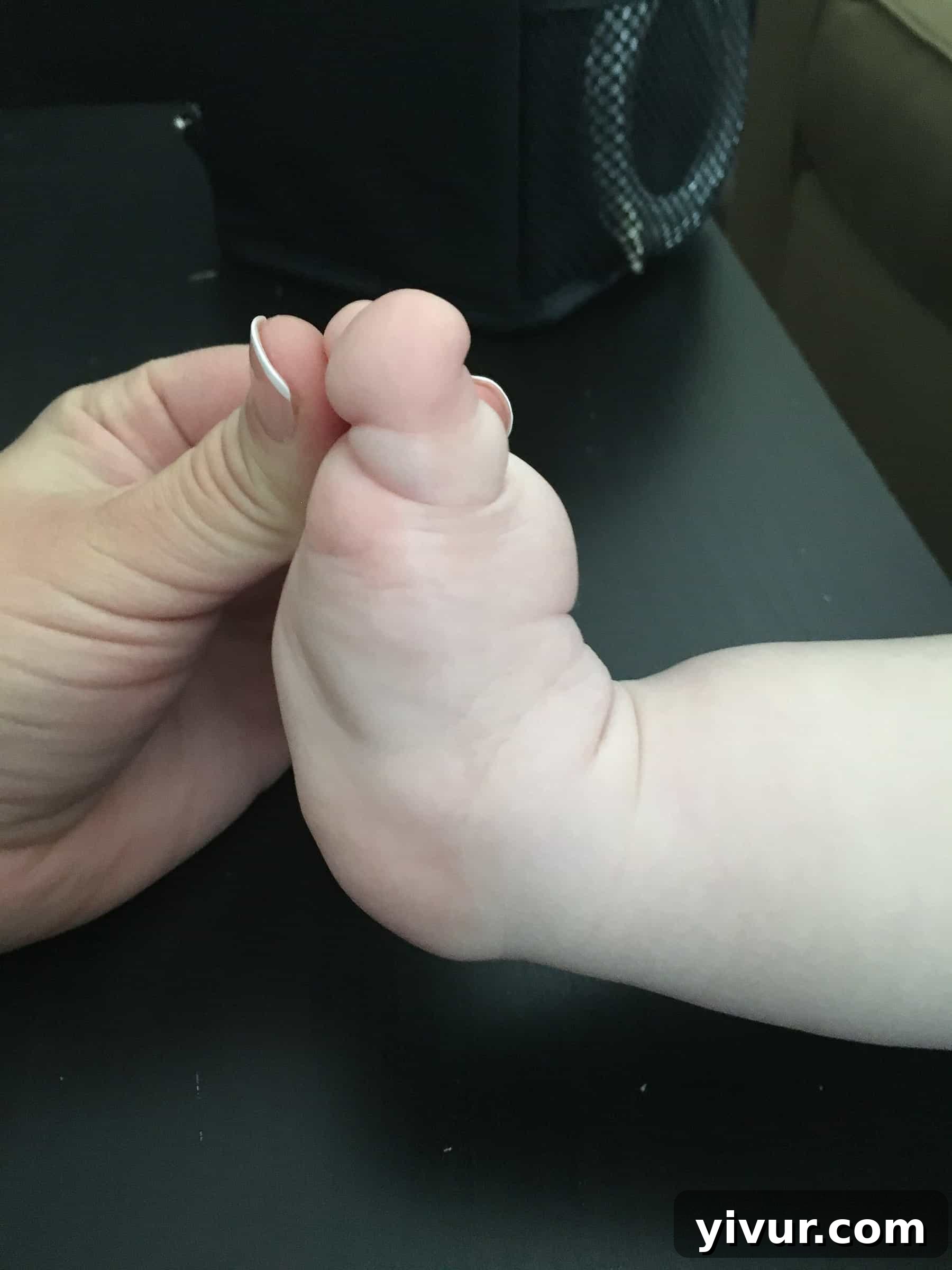 4 Yaşındaki Evladım Neden Alçıda ve Tekerlekli Sandalyede 9 Josh's feet before the second round of clubfoot correction, revealing an indistinct heel bone, a common challenge in complex clubfoot cases.