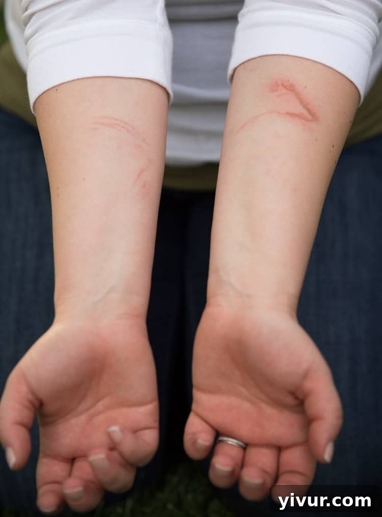 Airbag Injury: Cuts on Arm from Car Accident