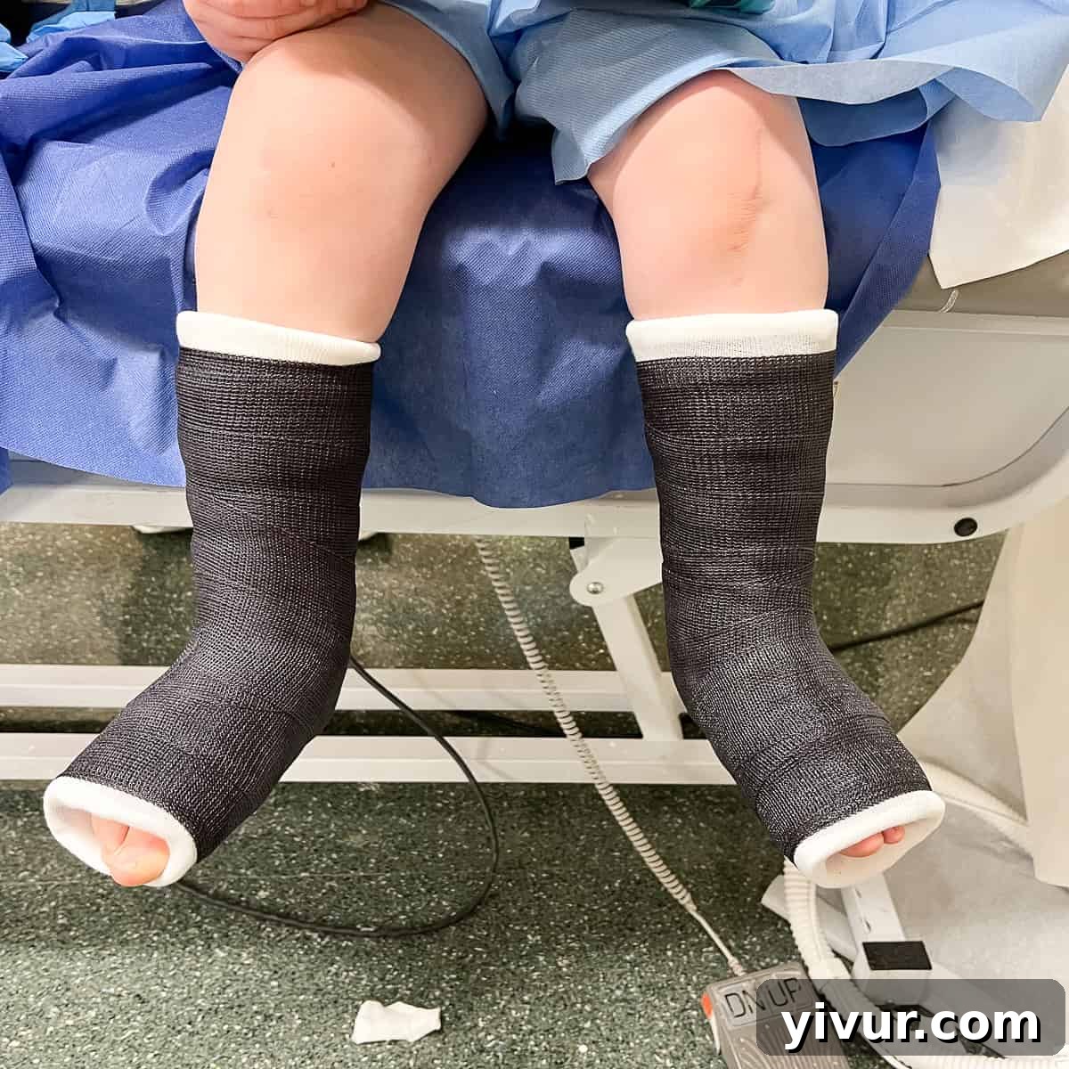 Josh's Unwavering Journey: Conquering Clubfeet 3 Close-up of Josh's leg in a vibrant blue cast, part of his ongoing clubfoot treatment, symbolizing strength and progress.