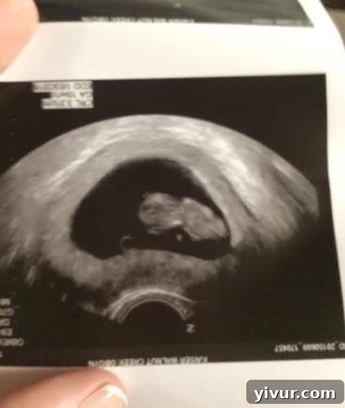 9 week Ultrasound showing a tiny developing embryo, a cherished early pregnancy moment.